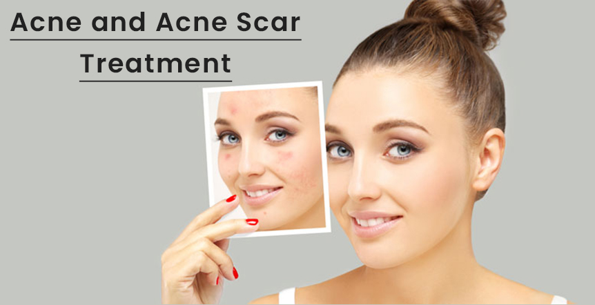 Acne and acne Scar Treatment Ahmedabad